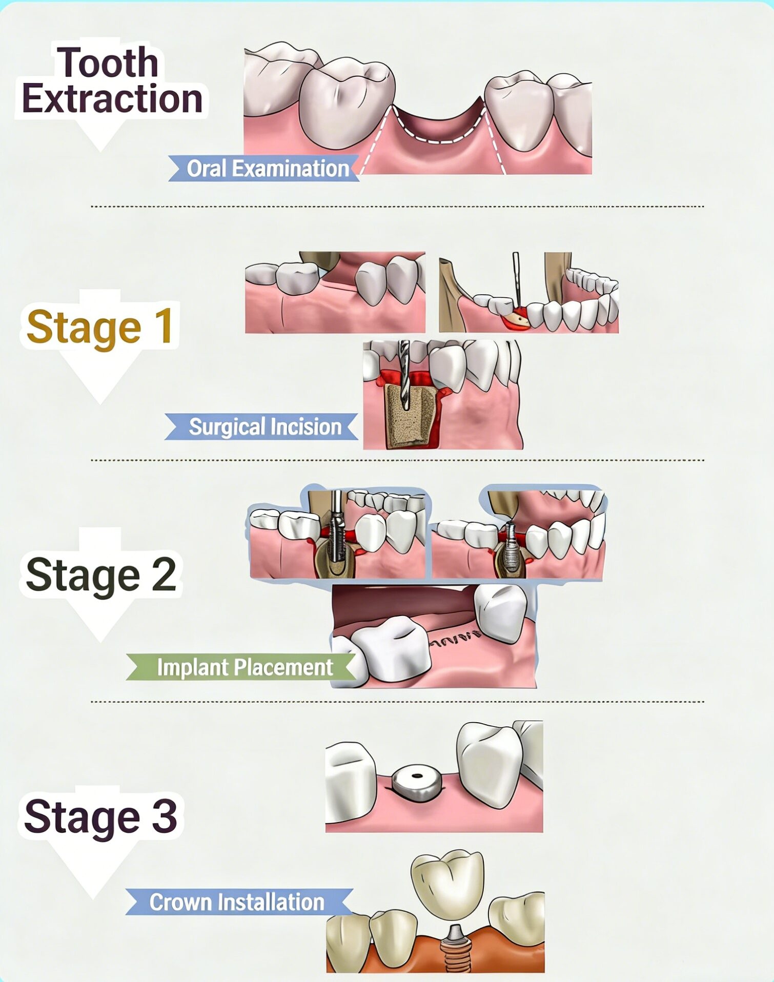 Dental Implant Process China
