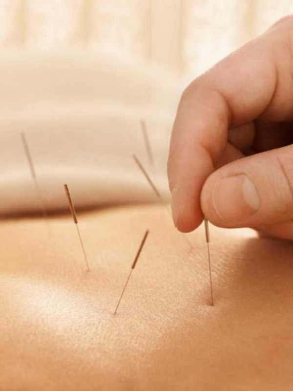 Acupuncture