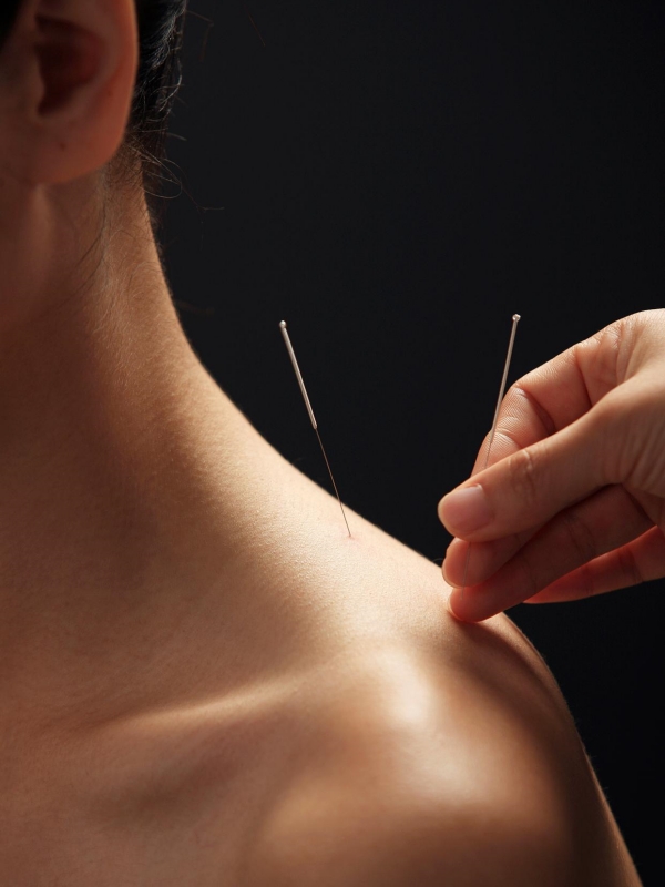 Acupuncture