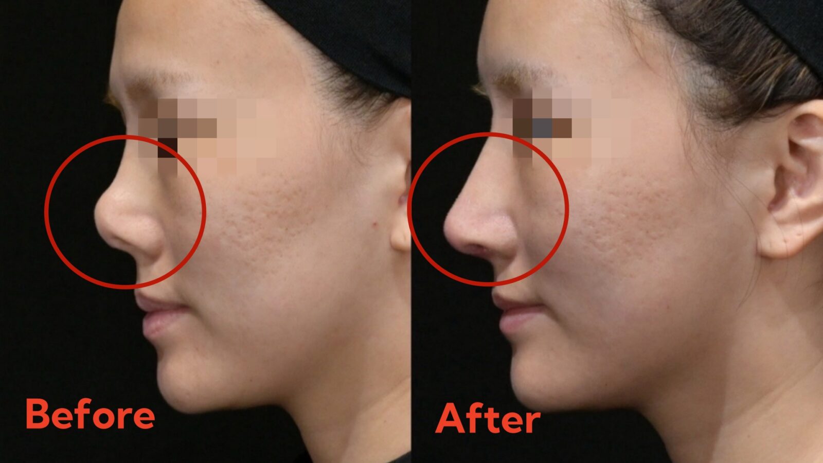 Rhinoplasty Before & After Comparison